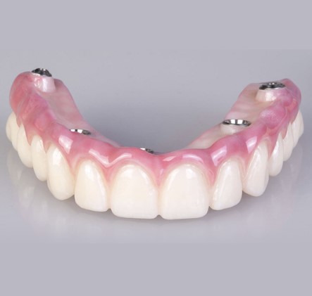 Prótese sobre Implantes